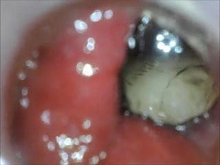 anal endoscope irritant play newcomer disabuse of inside