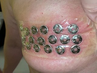 Removal be fitting of thumbtacks from the tits